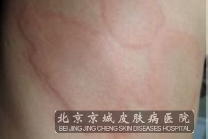过敏性荨麻疹能 吗