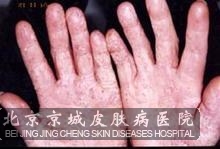 这类症状表现,一般和真菌感染,慢性 湿疹,维生素缺乏引发的皮肤皲裂