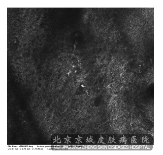 皮肤ct——监测你面颊中的黑色素