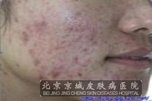 痤疮的护理方法是什么