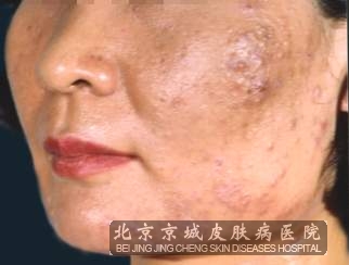 痤疮护理的办法有哪些