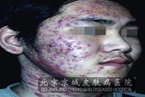 痤疮有痒痒的感觉怎么办