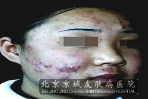 预防痤疮的出现生活中要注意什么