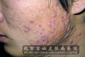 痤疮疤痕是怎么留下的