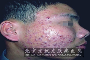 痤疮的基本症状是什么