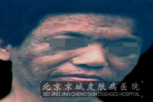 痤疮的预防办法有哪些