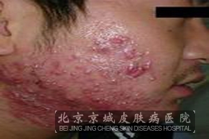 怎样治疗痤疮才不会复发呢