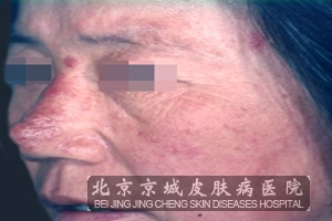 痤疮预防的生活注意事项有哪些