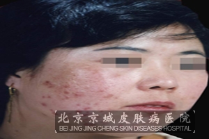 合理的饮食有助于痤疮的治疗