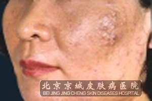 青春痘是怎么发作的