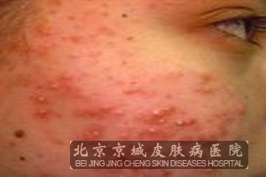 痤疮怎么治疗较好