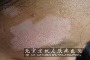 白癜风的发病原因 北京白癜风专科医院哪家好