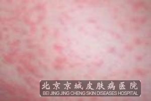 神经性皮炎的原因 京城百名专家大会诊 赵蒙-麦