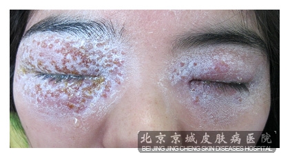 卡波西水痘样疹1例