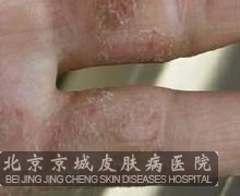 汗疱疹怎么治疗较好