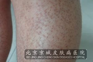 皮肤淀粉样变的治疗方法有哪些
