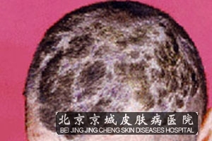 头上<em>长癣</em>是<em>怎么</em>回事--廊坊新闻网