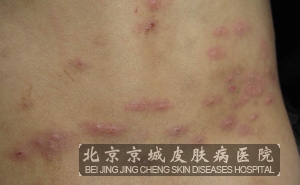 <em>胆碱能性荨麻疹</em>症状 治疗荨麻疹最好的医院--通