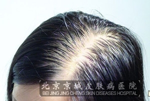 <em>女性脱发</em>原因,如何进行<em>治疗</em>