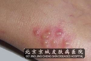 单纯疱疹早期症状有哪些