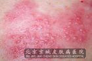阴部单纯疱疹病因有哪些