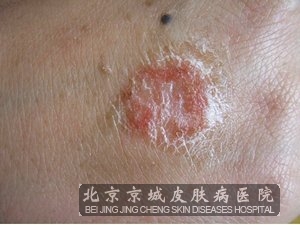 成人湿疹是怎么回事