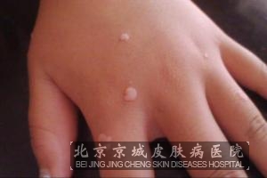 治疗扁平疣的偏方有哪些