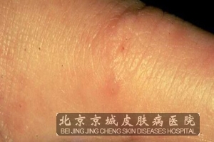 北京治疗疥疮最好的方法是什么 北京最好的皮