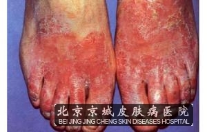 皮肤真菌感染症状有哪些