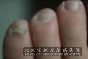 灰指甲的诊断依据是什么