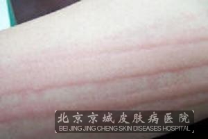 慢性荨麻疹能治好吗 北京皮肤病专科医院--廊坊