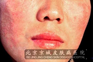 女性化妆品皮肤过敏怎样治疗