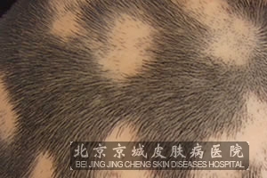 女性出现脱发该怎么办 京城治疗脱发最好的医