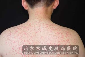 糠秕孢子菌毛囊炎症状