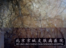 阴毛囊炎怎么办