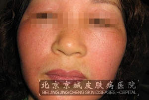 脂溢性皮炎症状有哪些