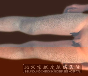 腿上鱼鳞病怎么治