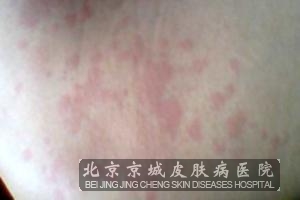 皮肤过敏忌吃什么食物