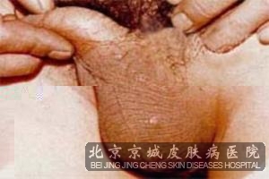 阴囊神经性皮炎是怎么引起的