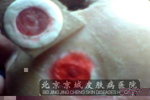 脚鸡眼怎么治疗才好