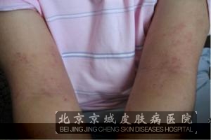 治脂溢性皮炎的偏方有哪些