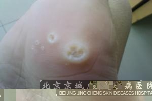 脚上长了鸡眼怎么治 - 资讯 - 铜仁网 - 铜仁市综