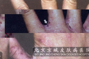 疥疮是怎么引起的 疥疮怎么治疗 - 资讯 - 铜仁网