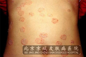 体癣的早期症状_北京治疗体癣的医院