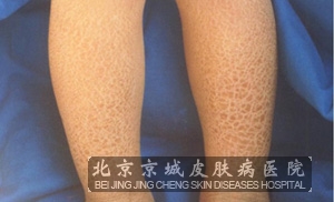 皮肤病的种类图片 北京皮肤病医院