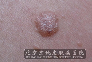>> 文章内容 >> 皮肤病的种类图片  最常见的皮肤病种类有哪些呢?
