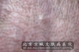 脂溢性皮炎的症状都有哪些