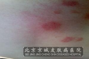 脂溢性皮炎的偏方有哪些