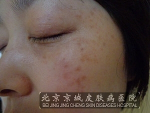 颧部褐青色痣怎么办 北京京城皮肤病医院