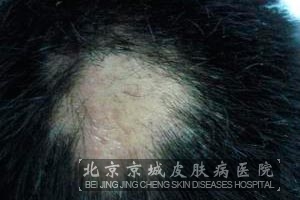 头痒脱发怎么办